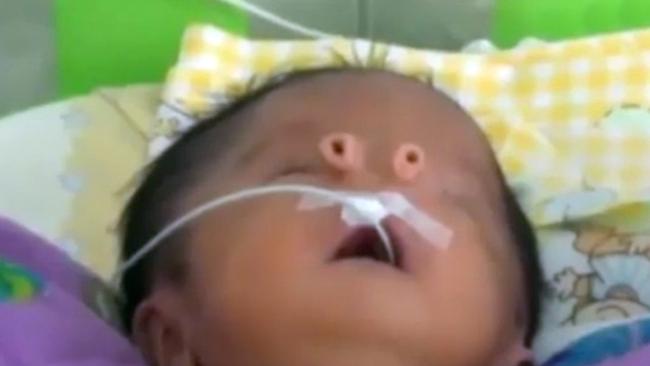 Shock birth ... Baby Angelito (little angel) was born with two tubes growing out of the side of his face, Otherwise healthy ... Doctors say it’s likely he suffers from no other problems.